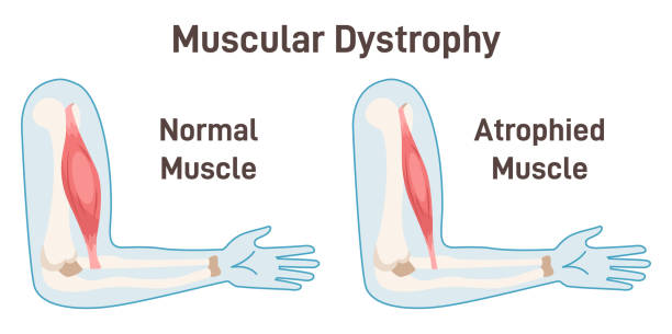 what is muscular dystrophy