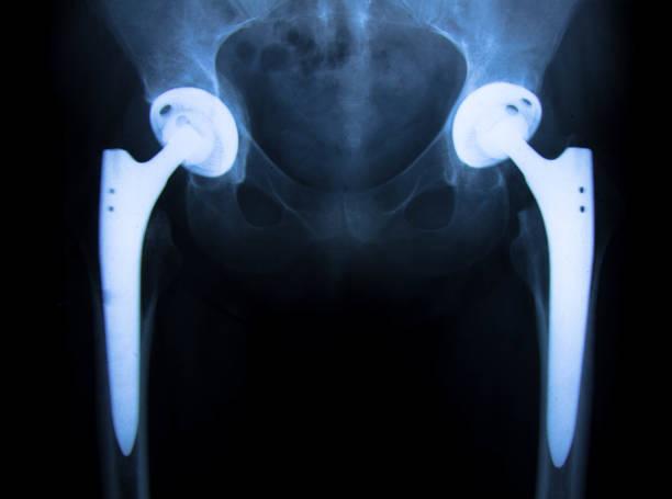 Bilateral Hip Replacement surgery in India
