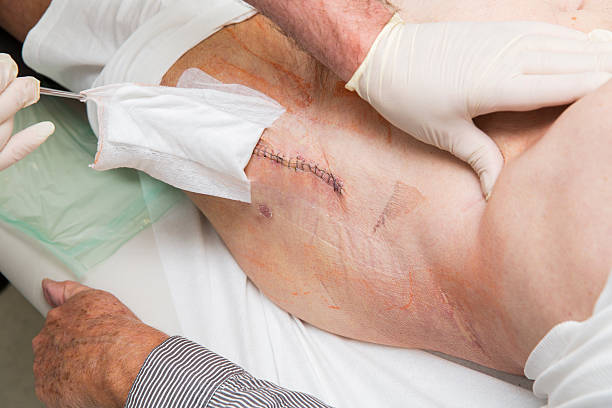 Minimally Invasive Hip Replacement (MIHR) surgery in India