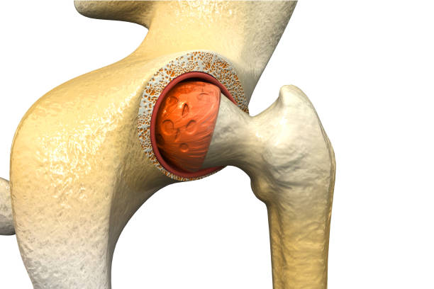 Partial Hip Replacement (Hemiarthroplasty) surgery in India